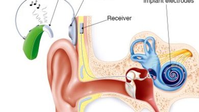 Photo of New law in Missouri to help pay for cochlear implants for adults on Medicaid