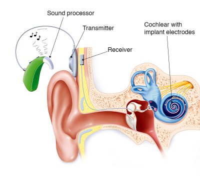 Cochlear implant illustration 800x706 400x353